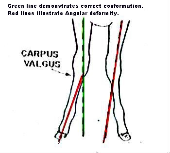 Angular leg deformity - Carpus Valgus